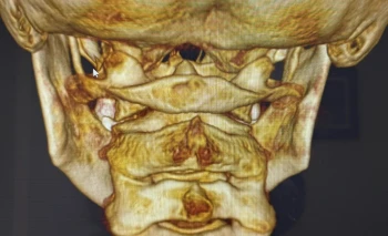 Chiari Malformation Relief and Treatment Sarasota and Lakewood Ranch