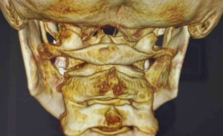 Chiari Malformation Relief and Treatment Sarasota and Lakewood Ranch