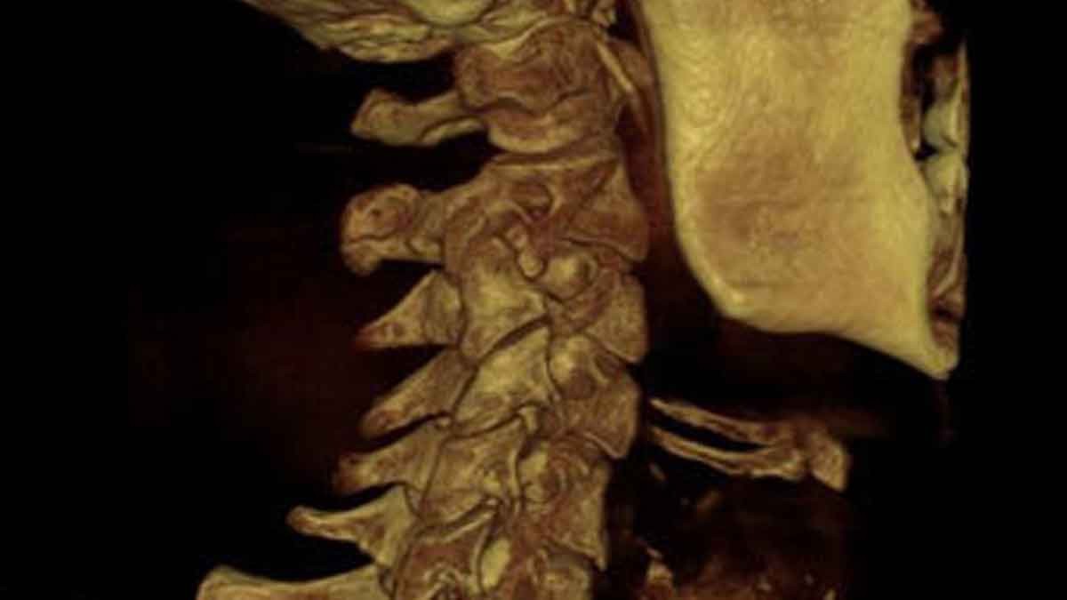 CLOSE LOOK AT C2 RIGHT ARTICULATION