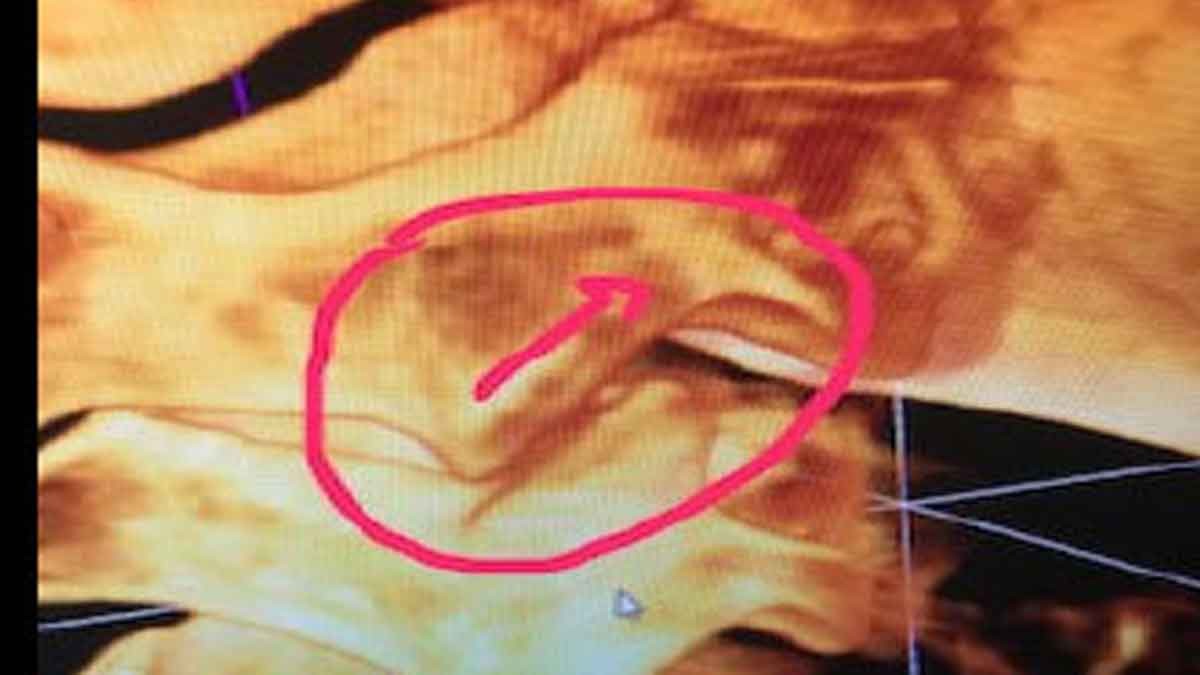 CLOSE LOOK AT C3, C4 ARTICULATION ON RIGHT