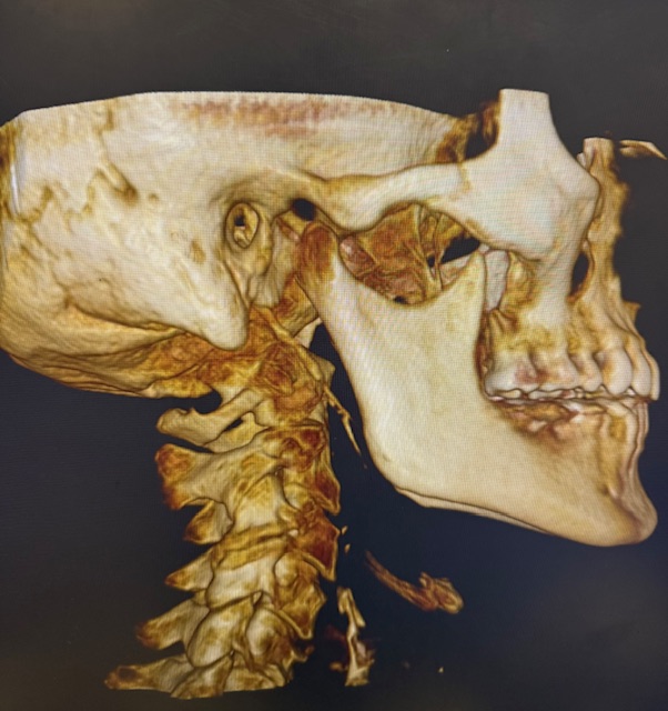 What Is Upper Cervical Chiropractic — And What It Is Not