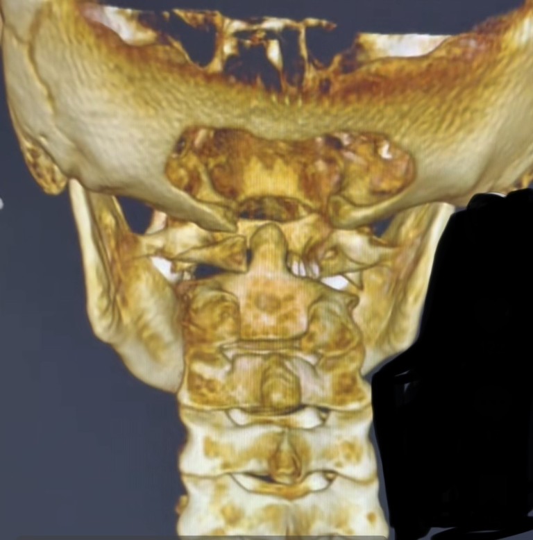 Chiari Malformation Healing After Surgery: A Sarasota Upper Cervical Success Story