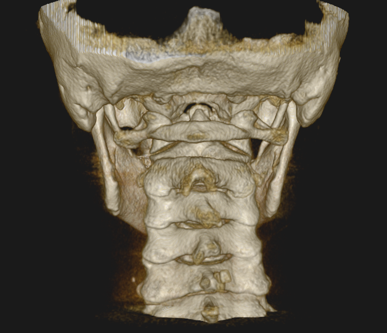 Head Pressure Relief and Treatment in Sarasota | Neck Misalignment Is Commonly the Missing Link