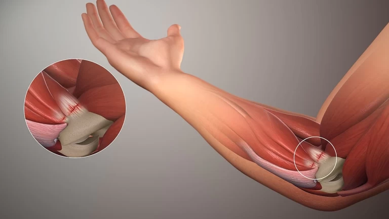 Chiropractic Care for Golfer’s Elbow